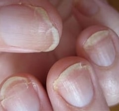 brittle nails causes
