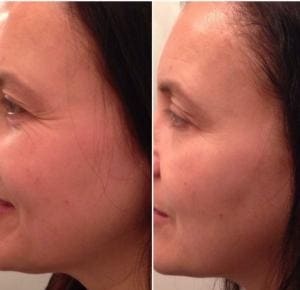rf facelift photo before and after