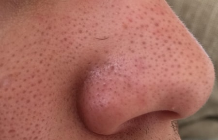 Skin pores black dots