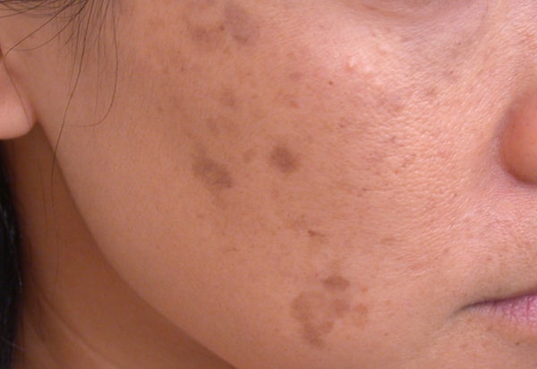 acne pigment spots