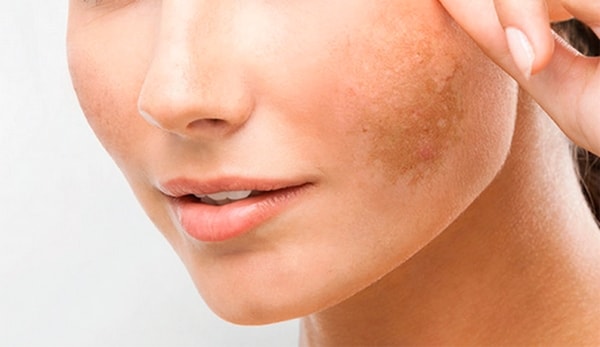 Melasma is a type of pigmented spot