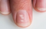 spots on nails