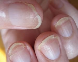 Ломкие ногти лечение